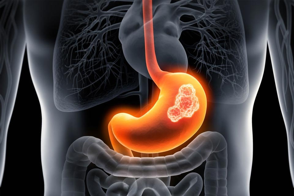 X-ray illustration of a stomach with highlighted tumor area.