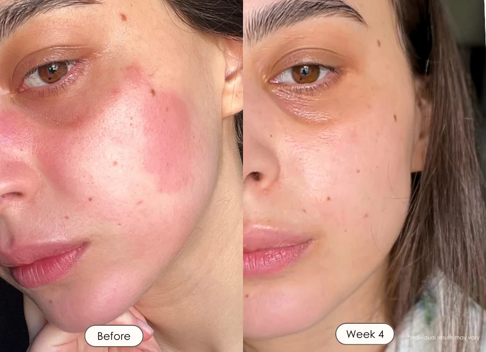 Before and after images of facial skin condition improvement over four weeks.