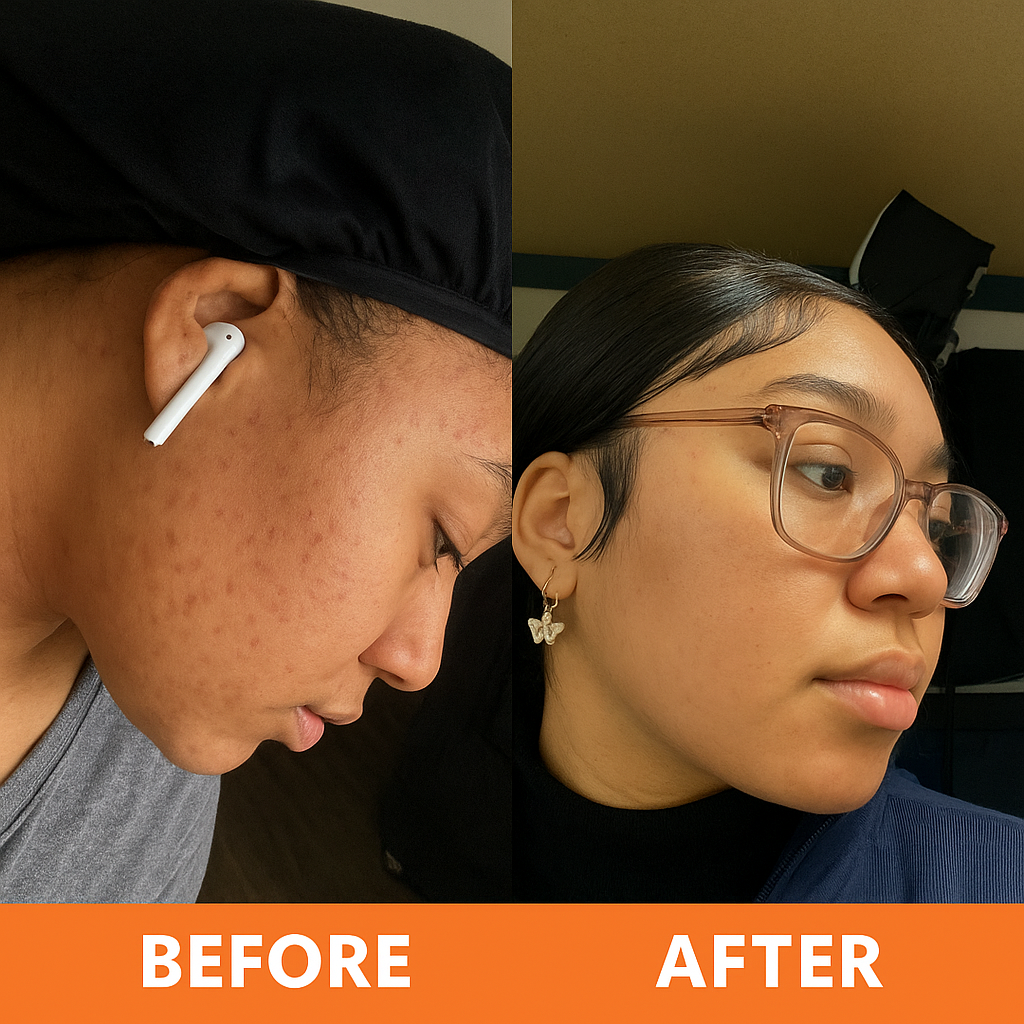 Side-by-side comparison of acne-prone and clearer skin in profile view.