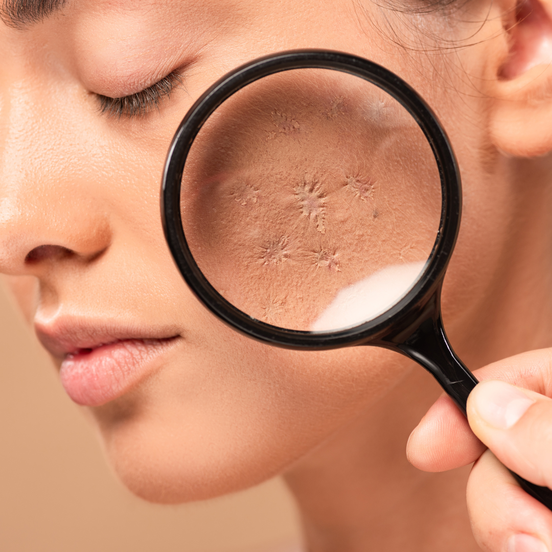 A close-up of a magnifying glass held over a person's cheek, showing their skin texture and pores.