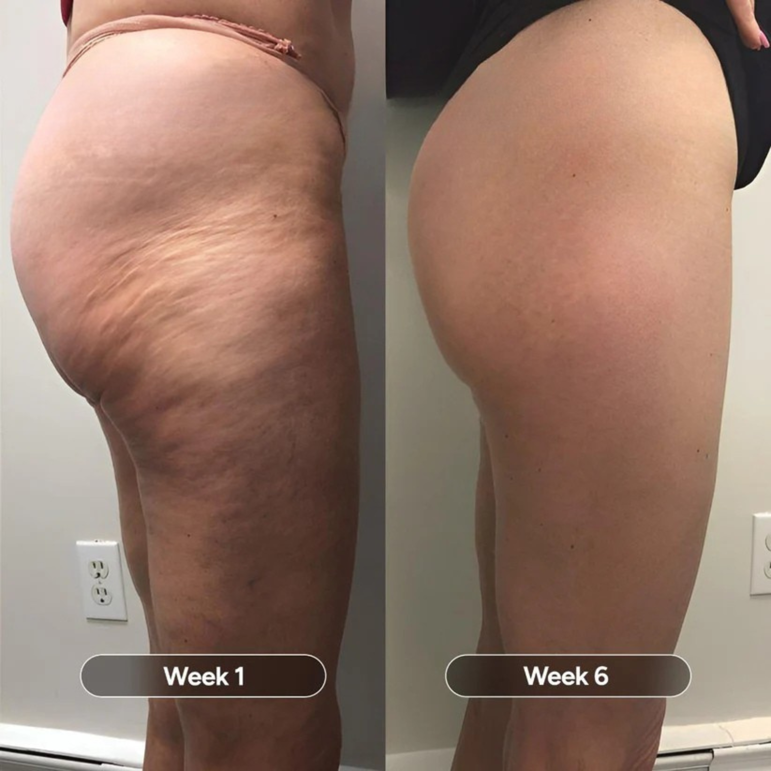Comparison of thigh appearance at Week 1 and Week 6.