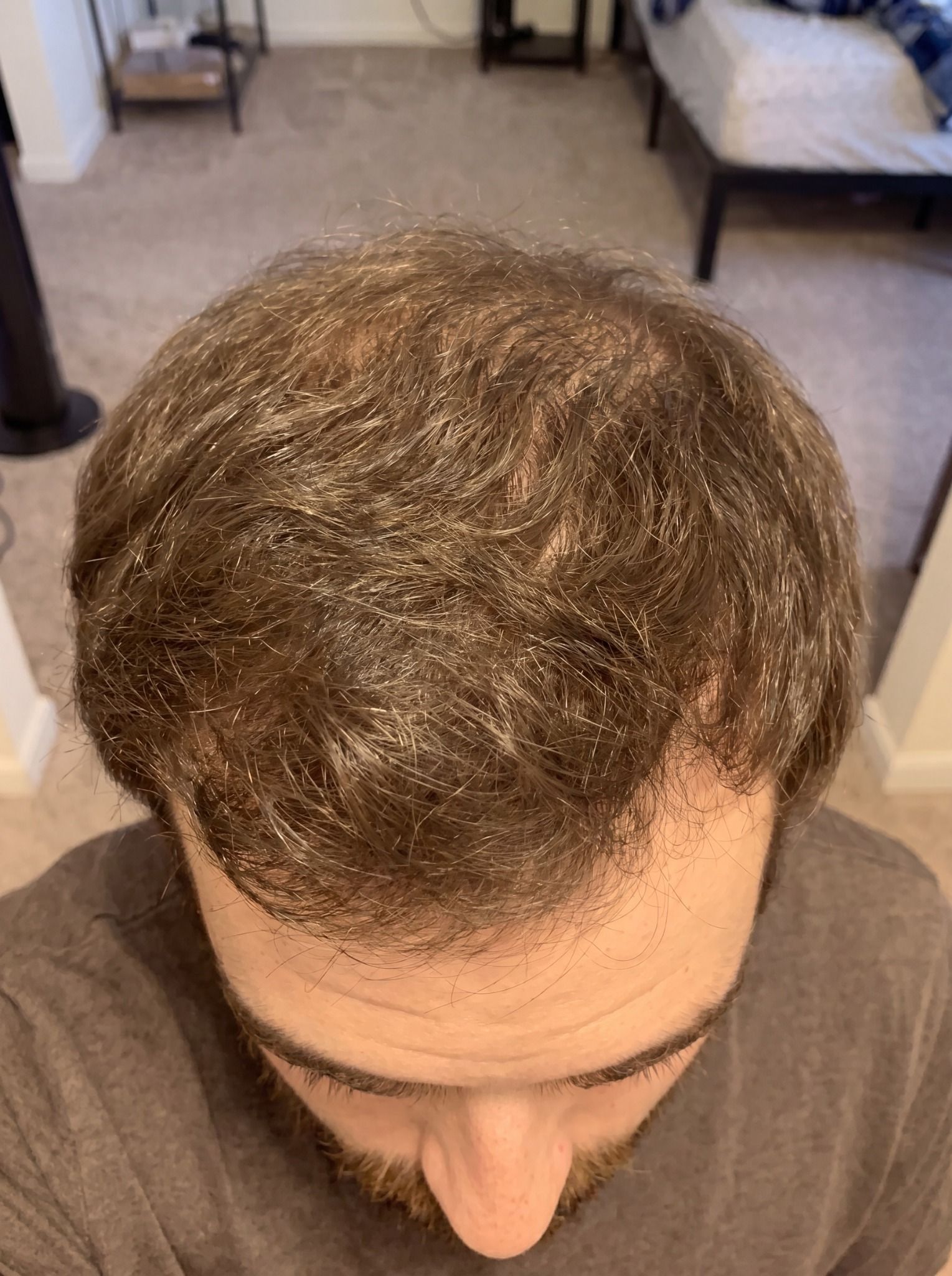 A top-down view of a man's head, showing thinning, wavy brown hair and the top of his forehead.