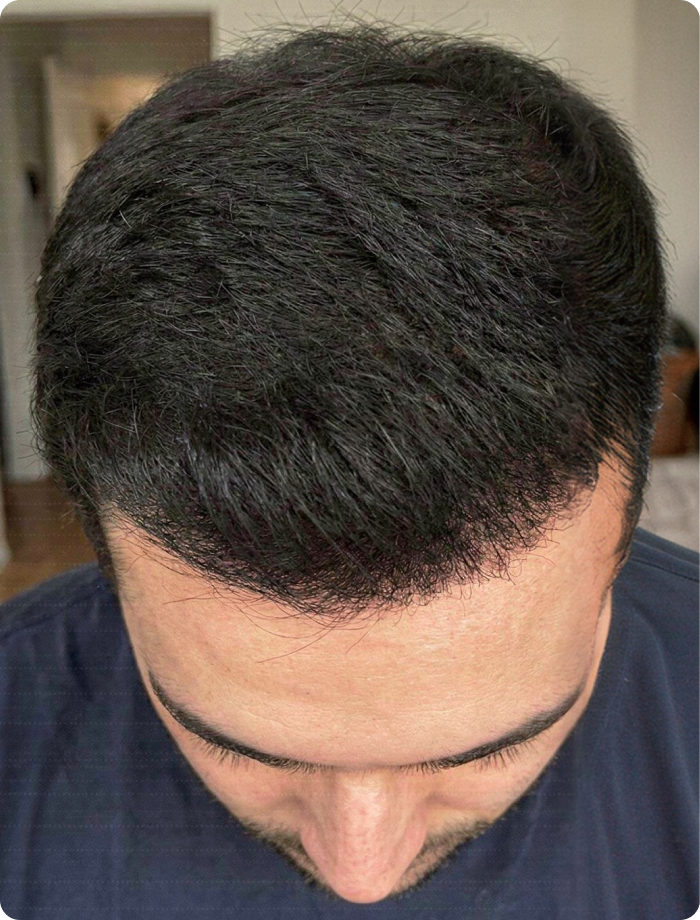 A top-down view of a man with a full head of thick, dark hair and a well-defined hairline.