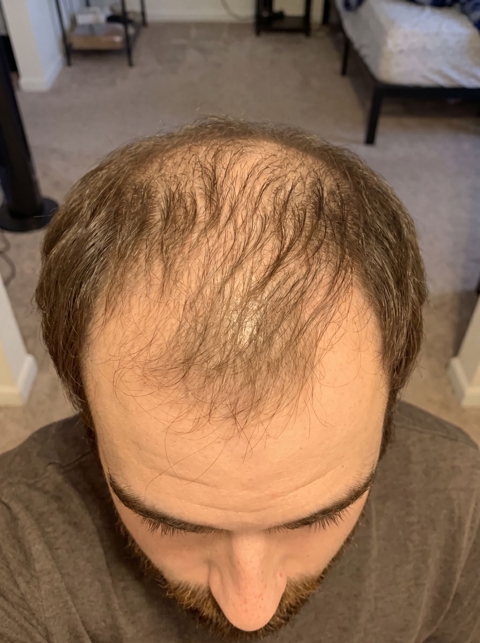 An overhead view of a man's head showing thinning brown hair on the crown and a receding hairline.