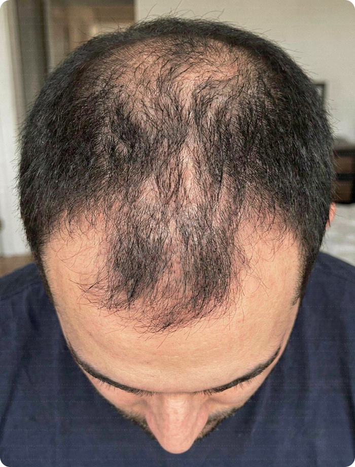 A top-down view of a man's head, showing thinning dark hair and a visible scalp.
