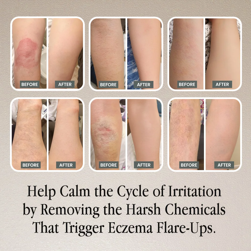 Before and after images of skin improvement with eczema treatment text.