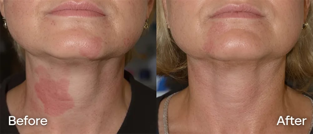 Comparación de irritación de cuello antes y después