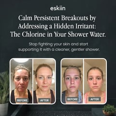 Skin before-and-after comparison photos with information about shower water