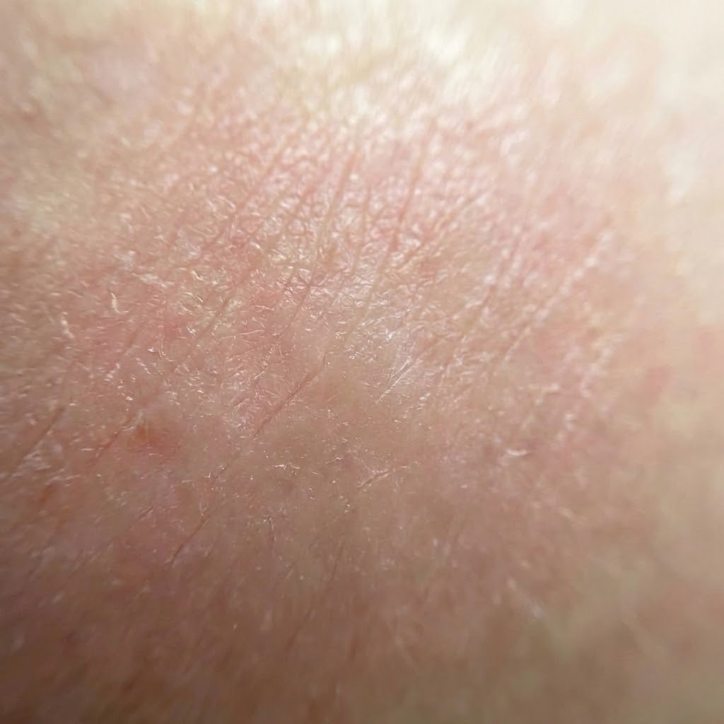 A close-up macro photograph of dry, flaky human skin.