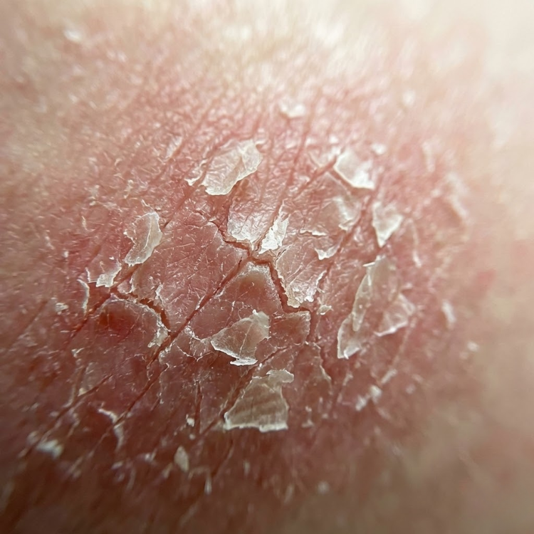 An extreme close-up macro photograph of dry, red, cracked, and flaking human skin.