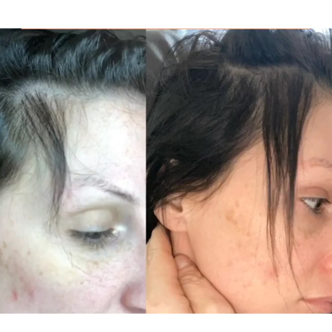Two side-by-side images of a woman's forehead and hairline for comparison.