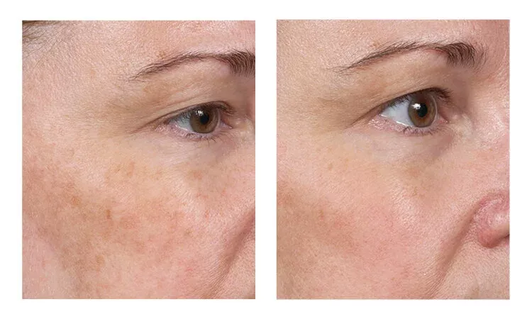 A before and after comparison showing reduced dark spots and more even skin tone on a woman's face.