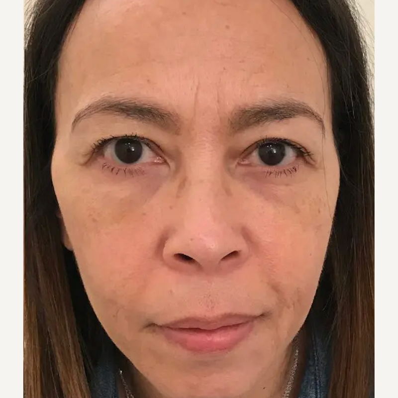 Close-up of a person's face with a neutral expression.