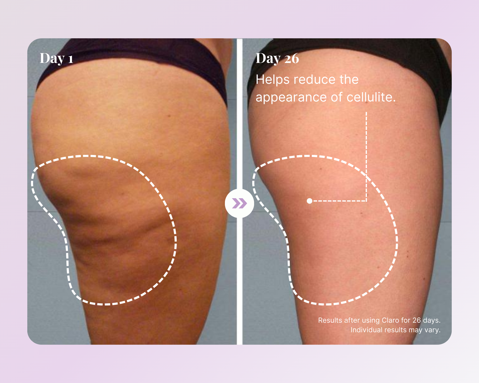 A before and after comparison of a thigh, showing a reduction in the appearance of cellulite after 26 days.