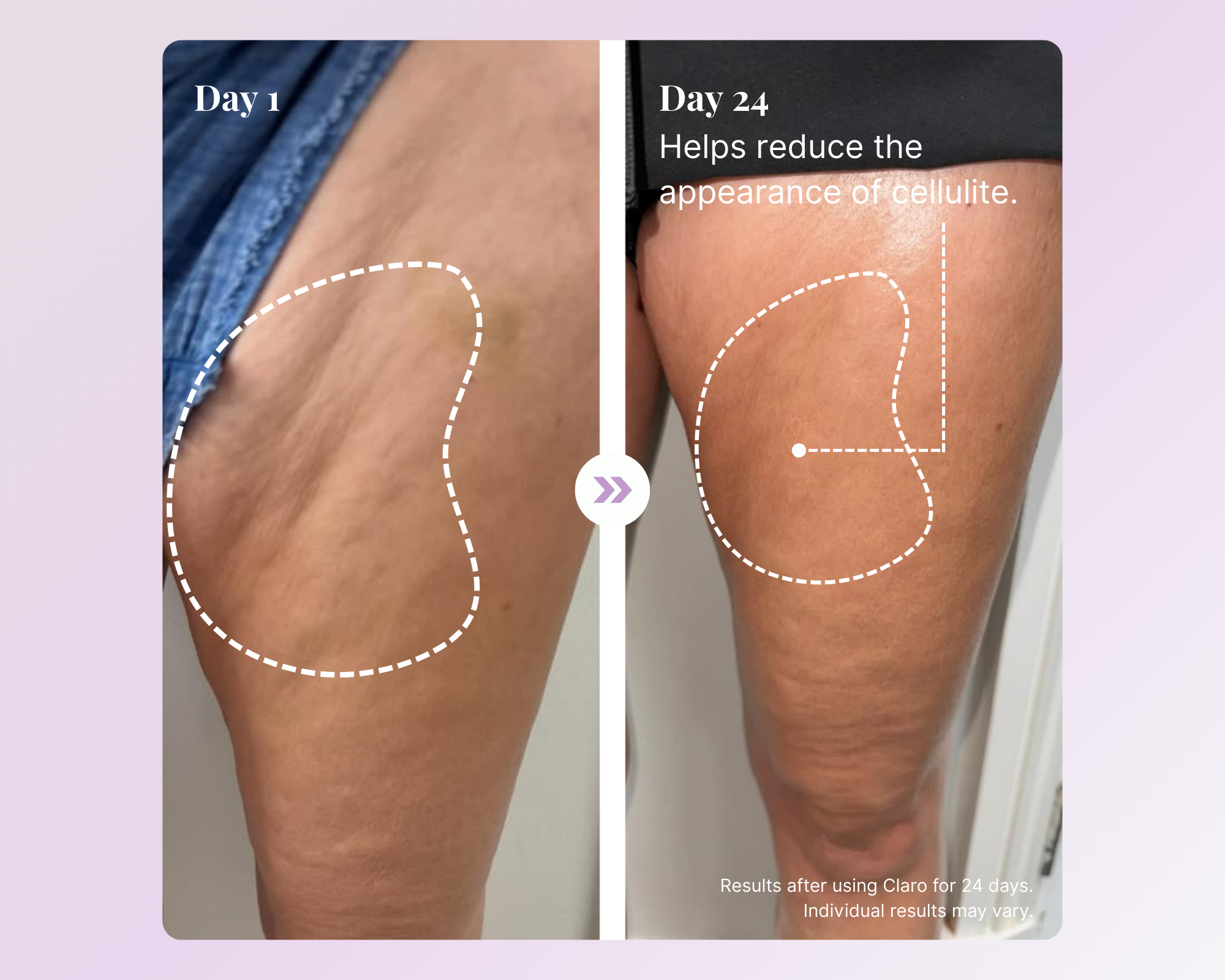 A before and after image showing the reduction of cellulite on a person's thigh over 24 days.
