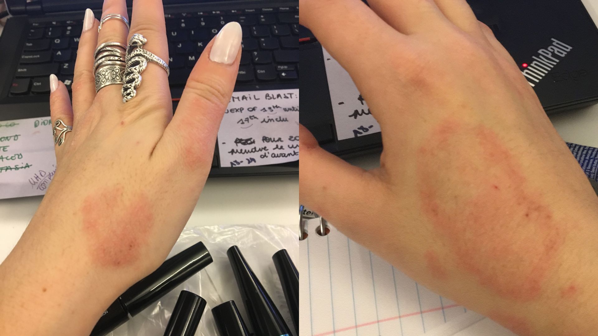 A split-screen image showing two views of a red rash on the back of a person's hand.