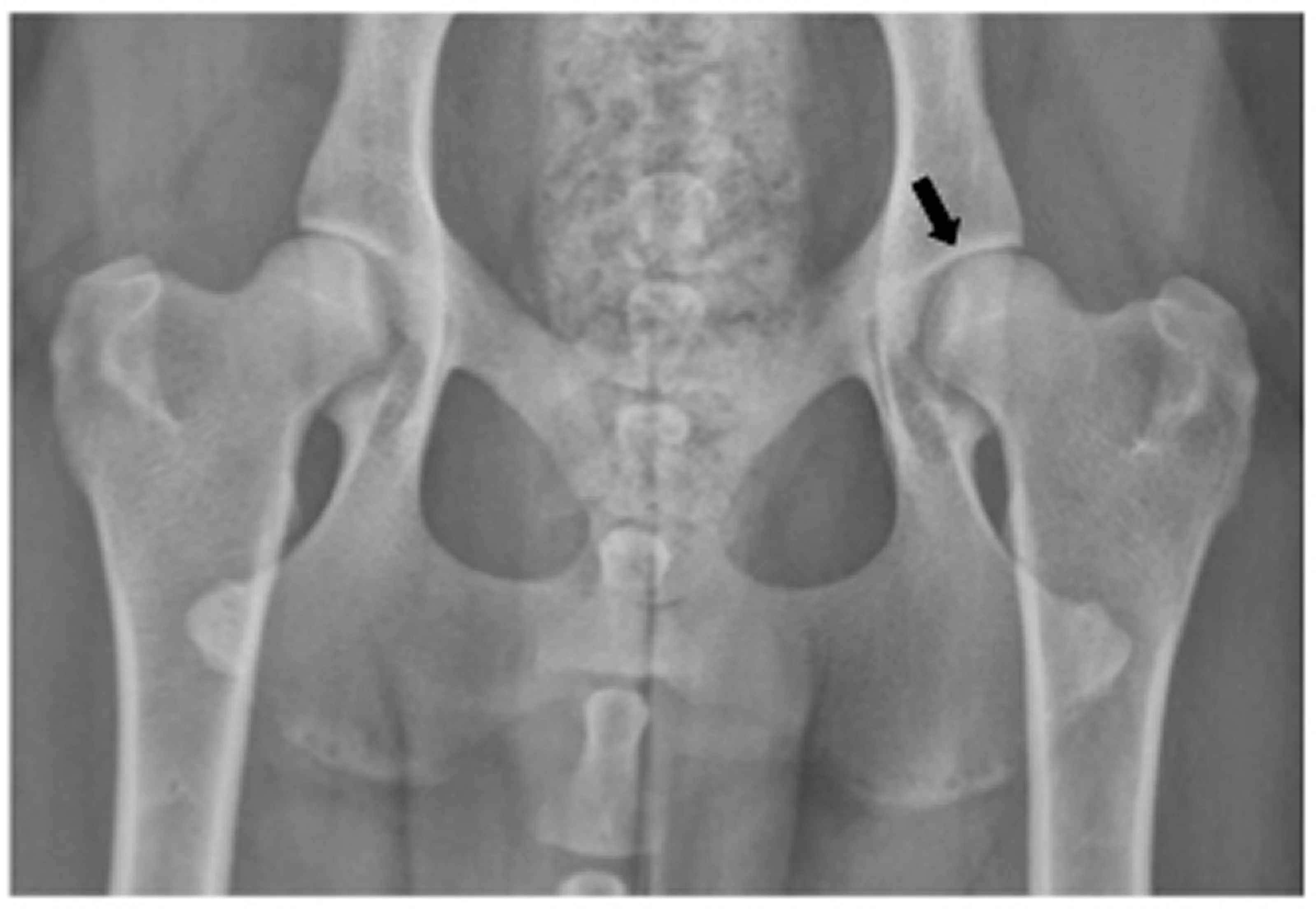 X-ray of hip bones with an arrow pointing to the right hip joint.