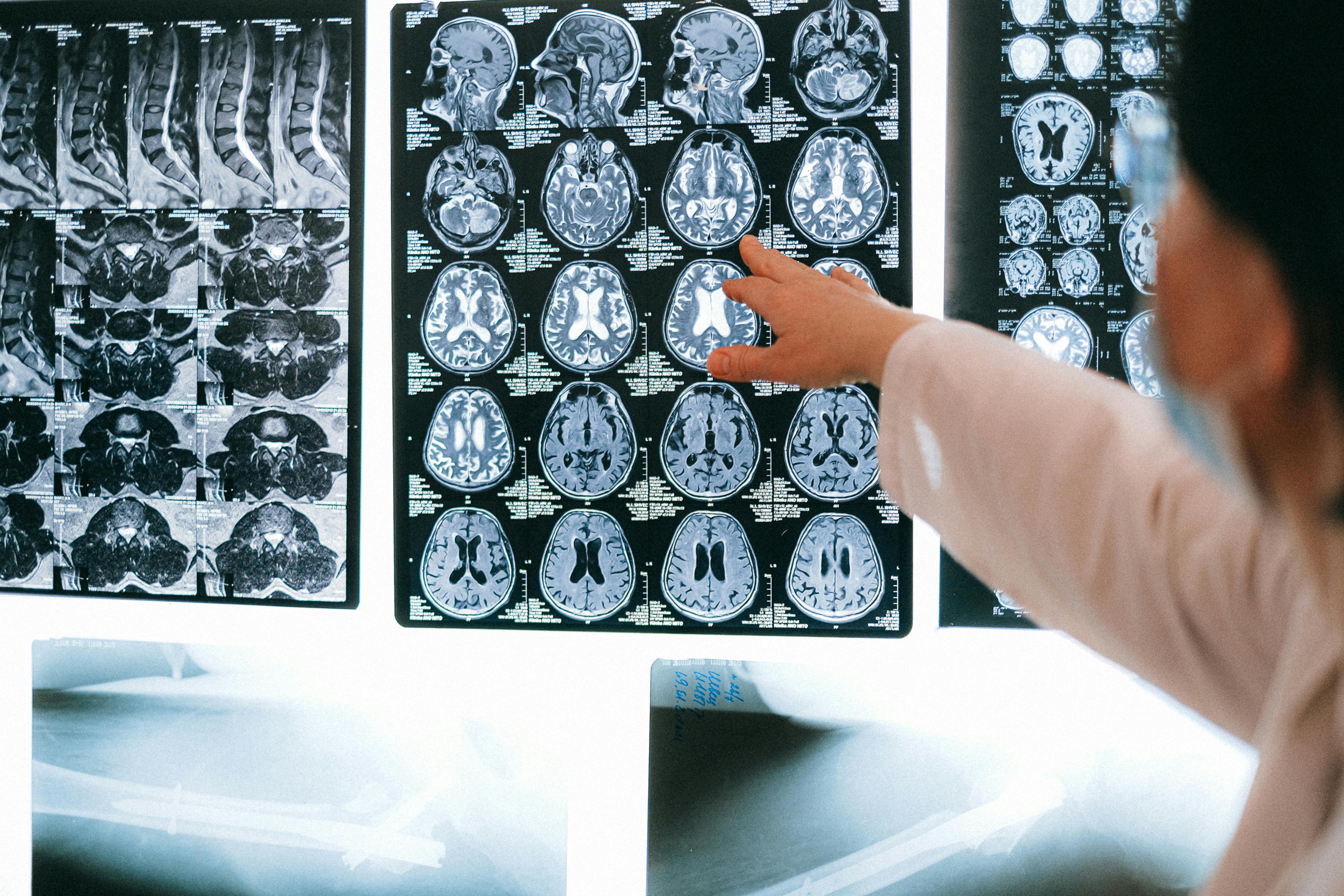 A person in a white coat points to a film showing multiple MRI scans of a human brain.