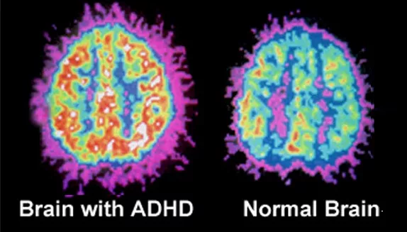 A side-by-side comparison of two colorful brain scans, one labeled 'Brain with ADHD' and one 'Normal Brain'.