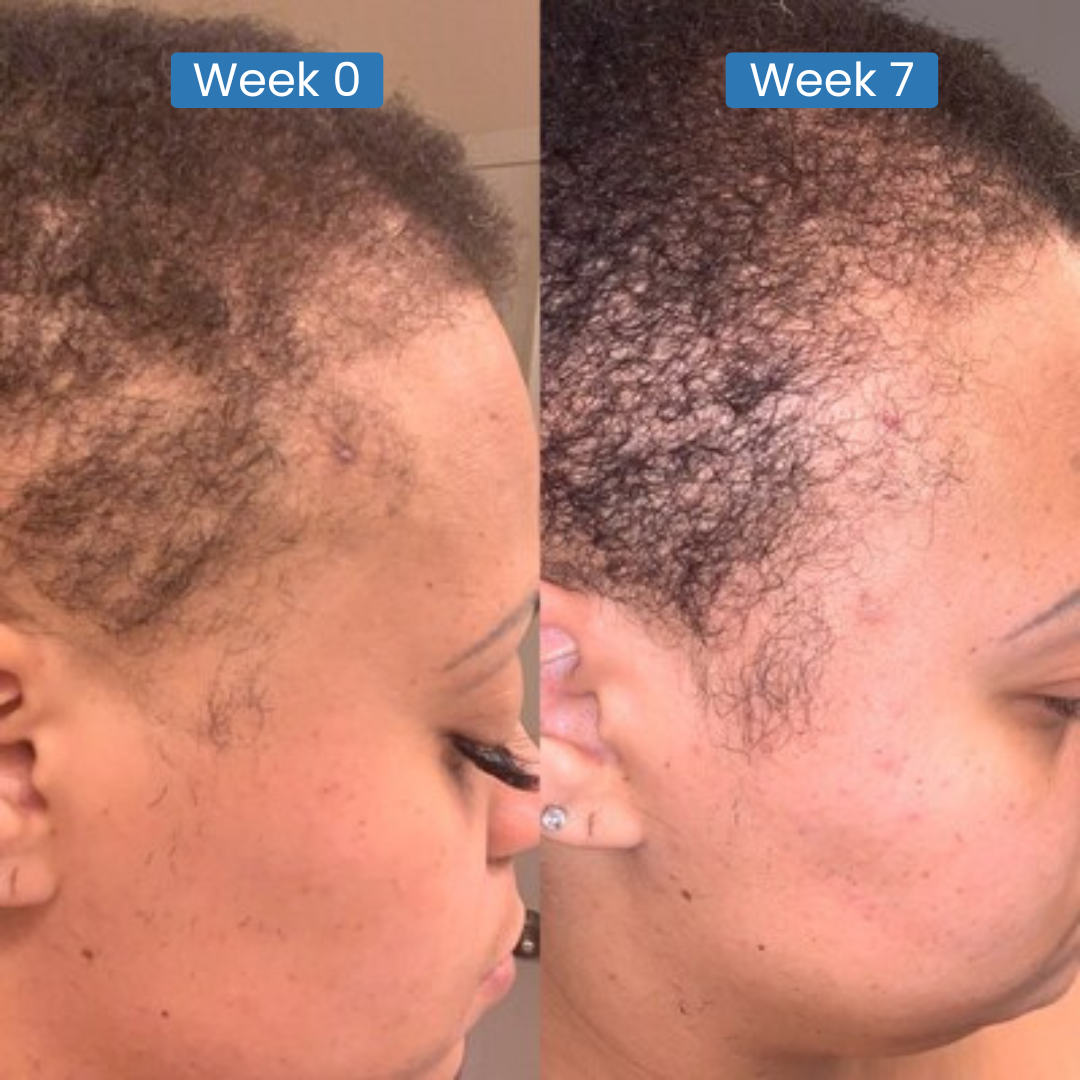 Side-by-side comparison of hair growth from week 0 to week 7 on a person's scalp.