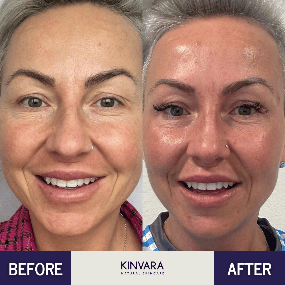 Side-by-side comparison of a woman's face before and after using skincare products.