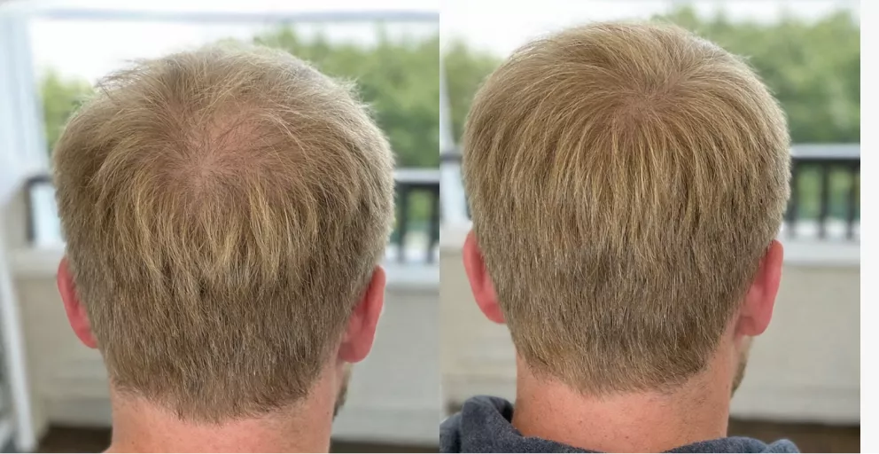 A before and after comparison of a man's thinning crown, showing thicker hair in the second image.