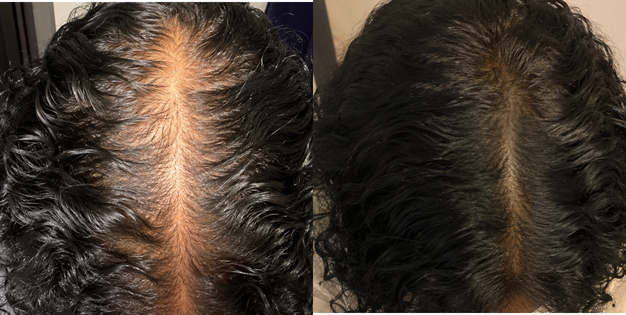 A side-by-side comparison of the top of a person's head, showing thinner hair on the left and fuller hair on the right.