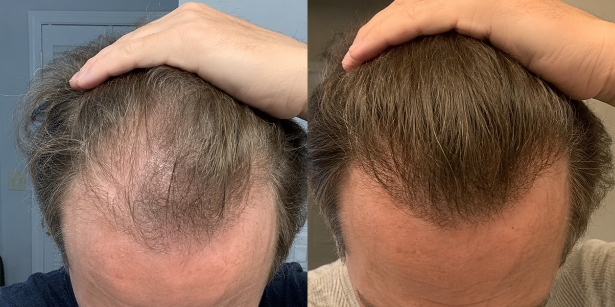 A side-by-side comparison of a man's hairline, showing thinner hair on the left and thicker hair on the right.