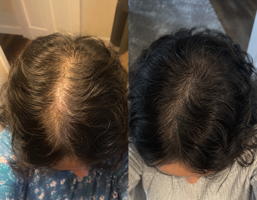 A side-by-side comparison of a person's scalp, showing hair thinning on the left and fuller hair on the right.