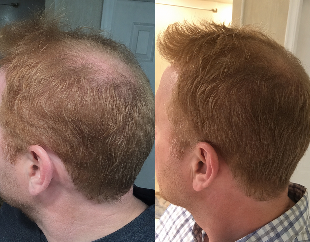A before-and-after comparison showing hair regrowth on the crown of a man's head.