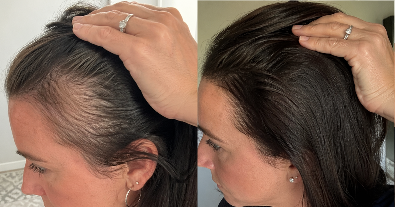 Side-by-side images of a woman's hairline, showing thinner hair on the left and fuller hair on the right.
