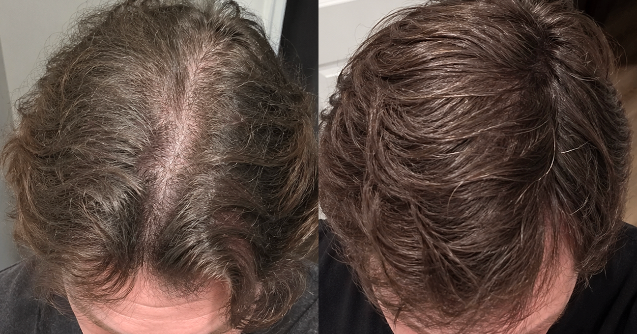 A side-by-side comparison showing thinning hair on the left and fuller, thicker hair on the right.