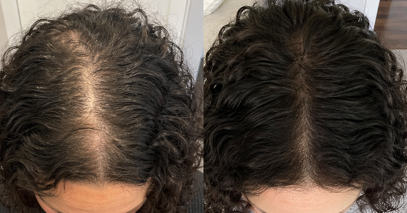 A before-and-after comparison of a person's curly hair, showing increased hair fullness and less visible scalp.