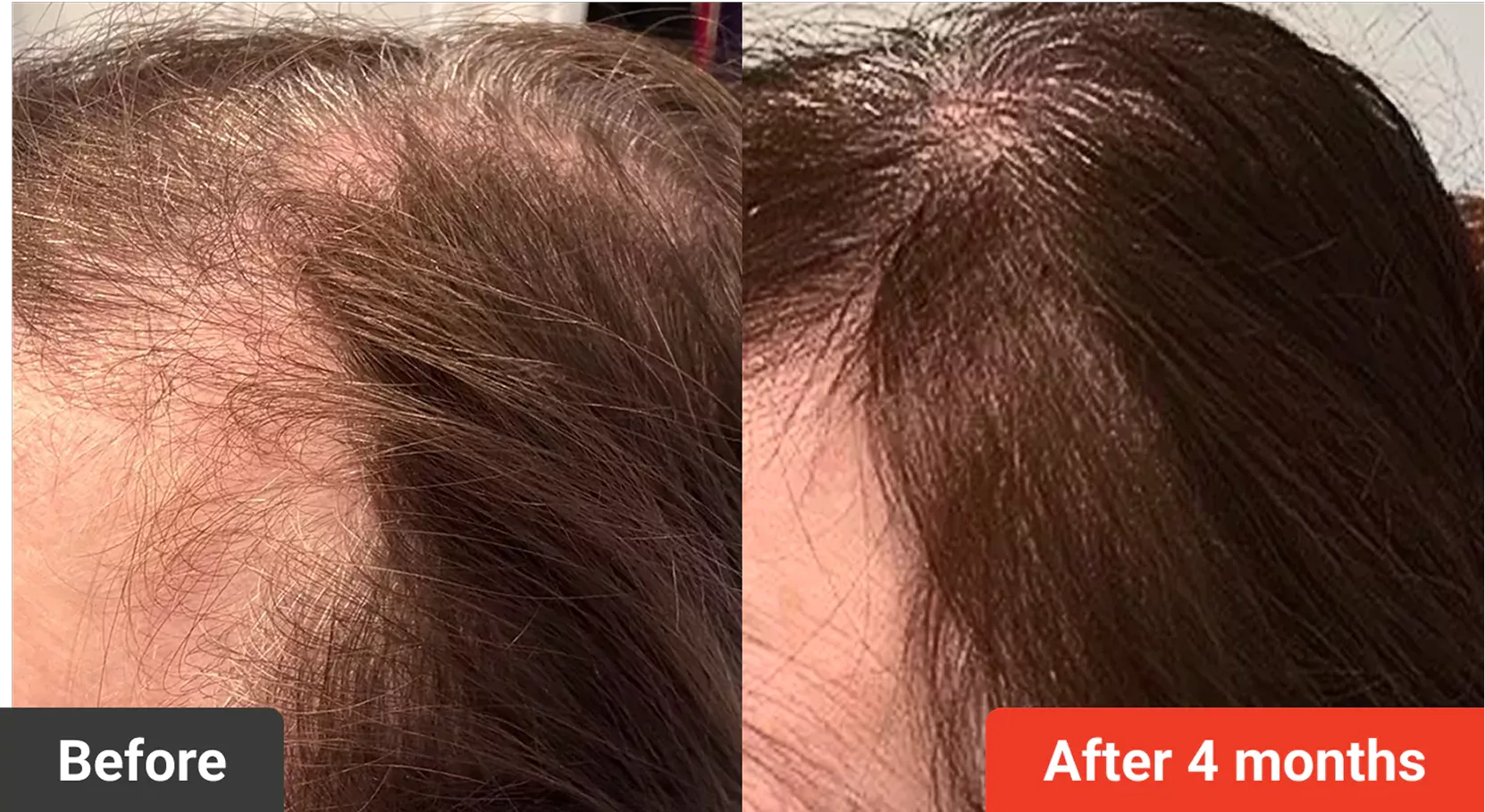 A before and after comparison showing hair regrowth on a person's scalp over four months.