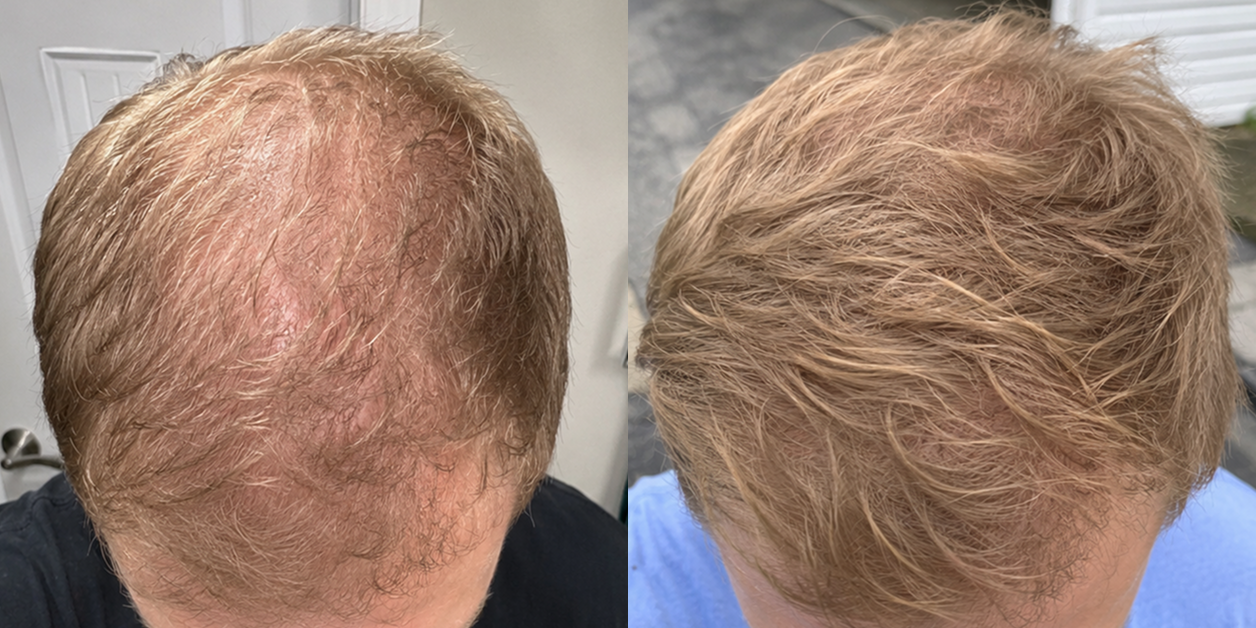 A before-and-after comparison of the top of a man's head, showing increased blond hair density.