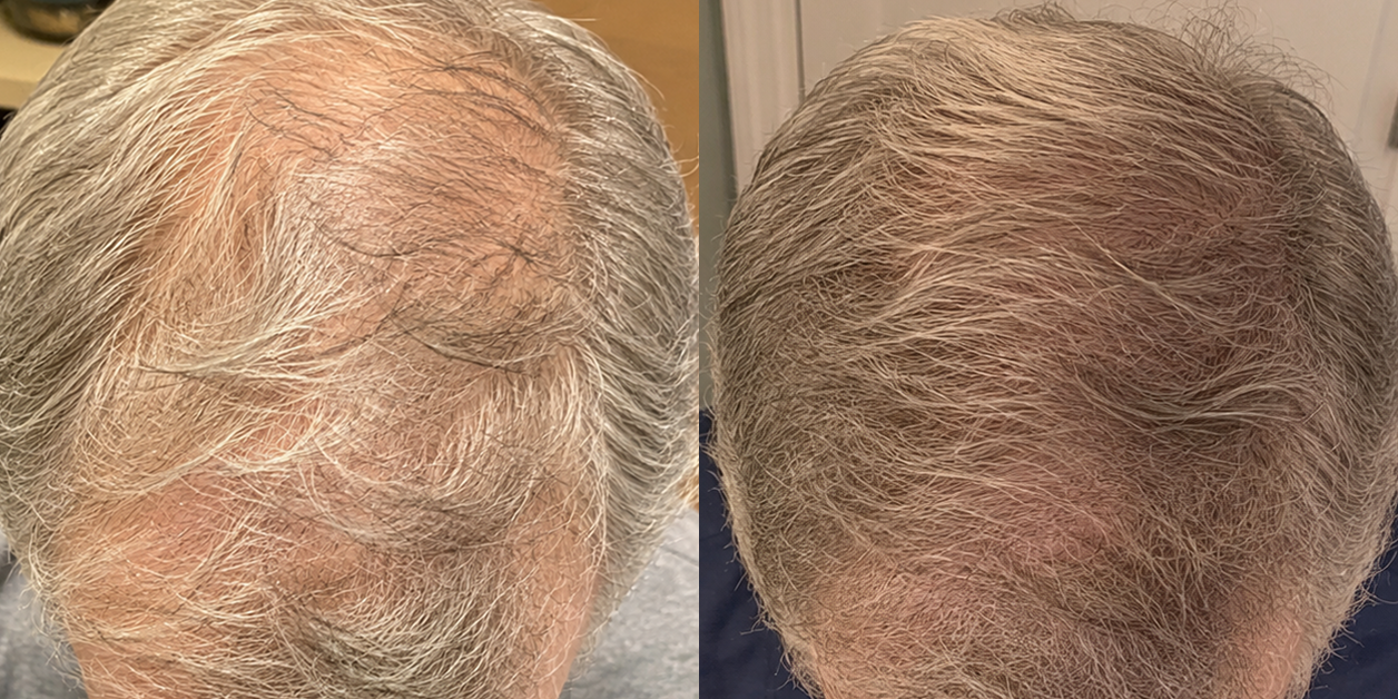 A before-and-after comparison of the top of a head, showing thinning hair on the left and fuller hair on the right.