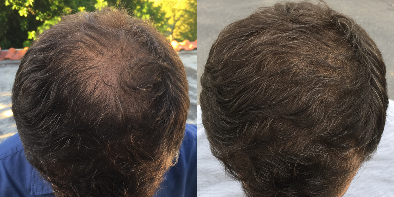 A before and after comparison showing hair regrowth on the crown of a man's head.