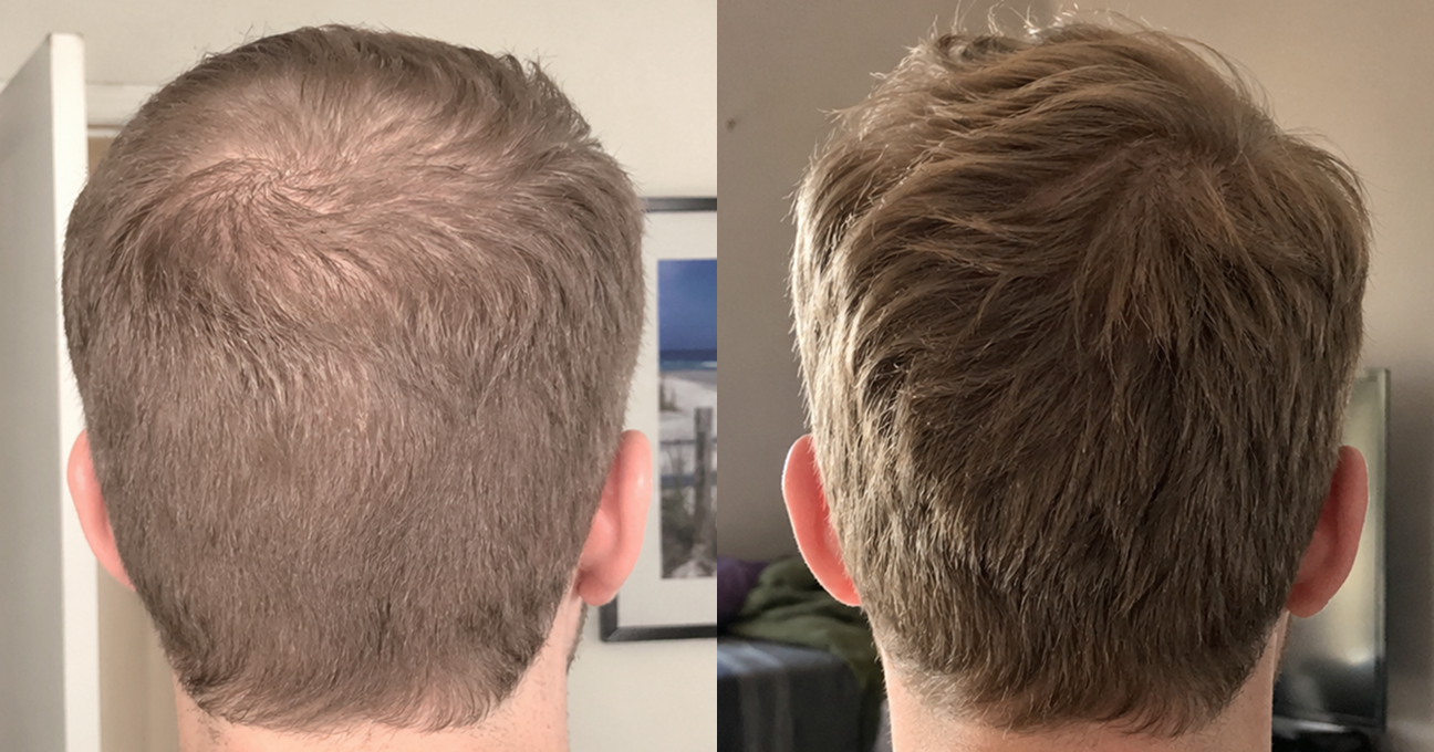 A before and after comparison of the back of a man's head, showing hair regrowth on the crown.