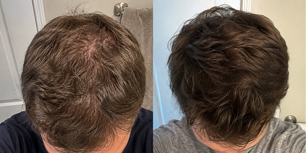A side-by-side comparison of a man's hair, showing thinning on the left and thicker, fuller hair on the right.