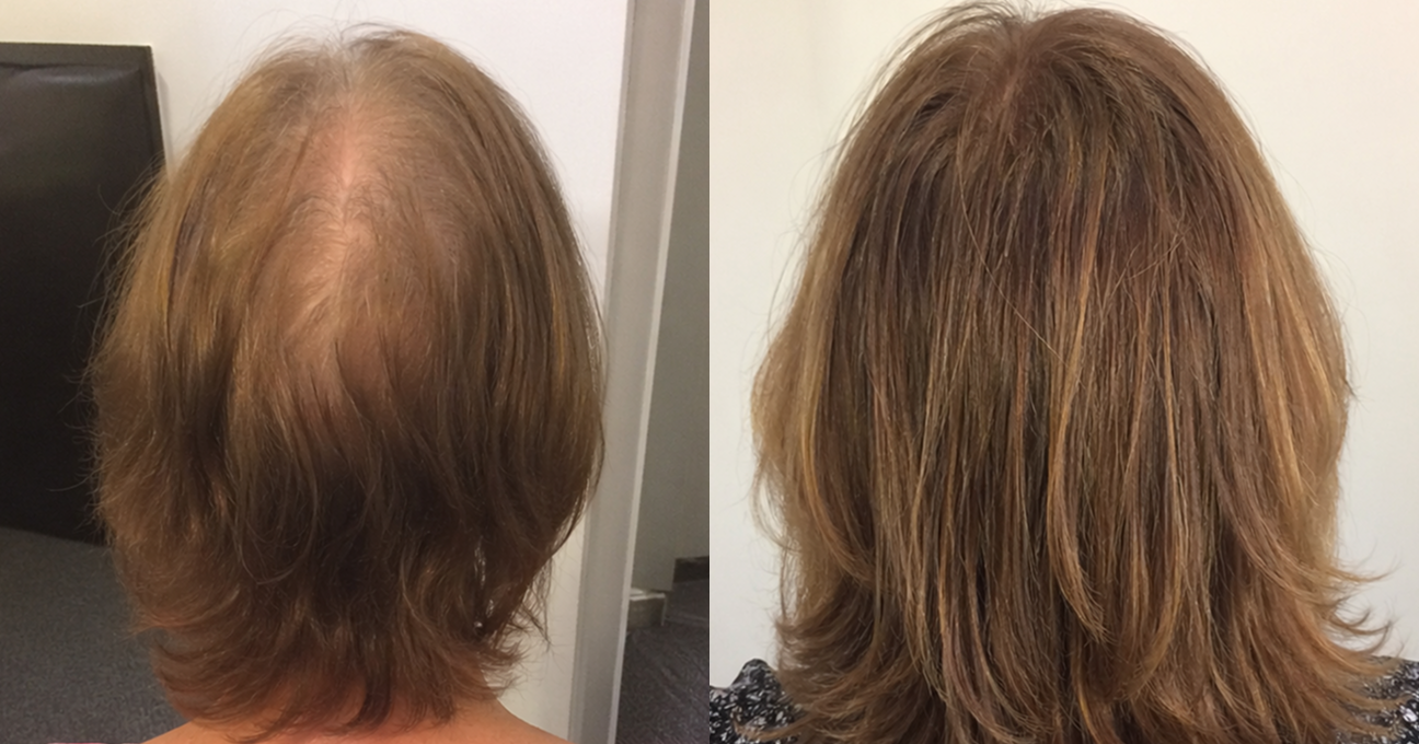 Before-and-after view of a woman's hair from behind, showing thinning hair on the left and fuller hair on the right.