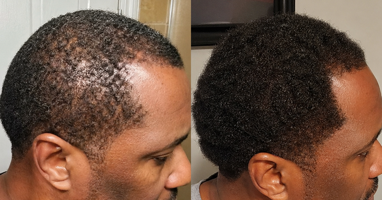 A before-and-after image showing a man's hair growth from thin and sparse to thick and full.