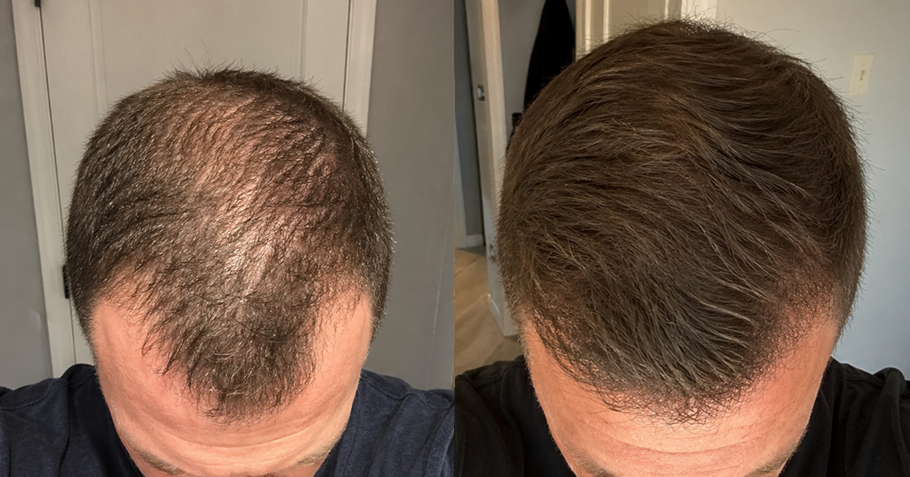 A before and after comparison of a man's hair, showing thinning hair on the left and thicker hair on the right.
