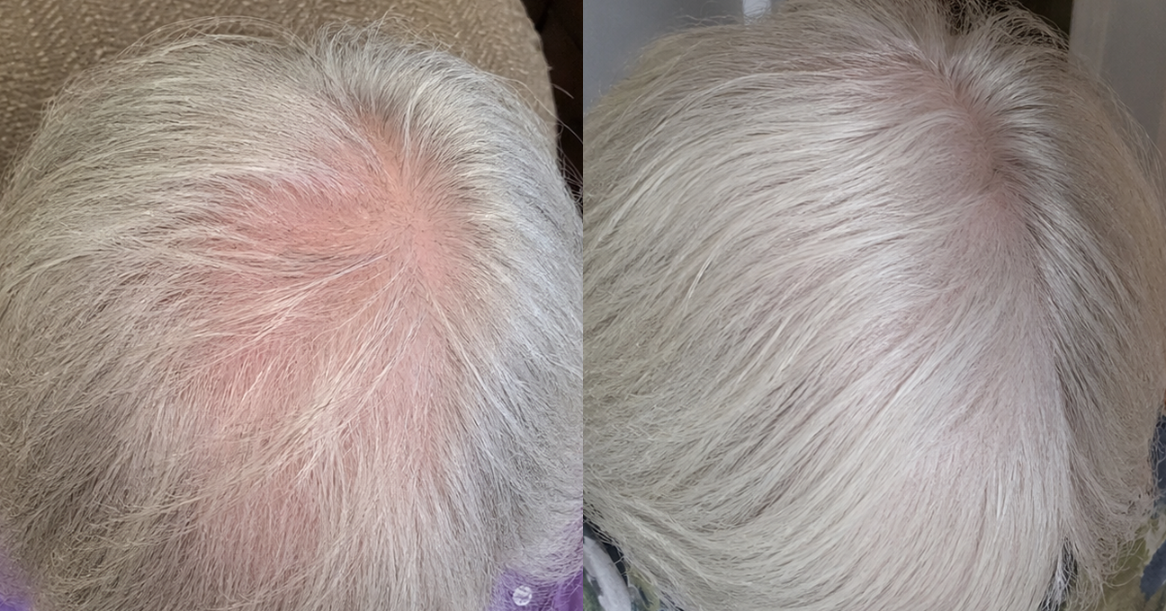 A before and after comparison showing increased fullness in thinning white hair on a person's scalp.