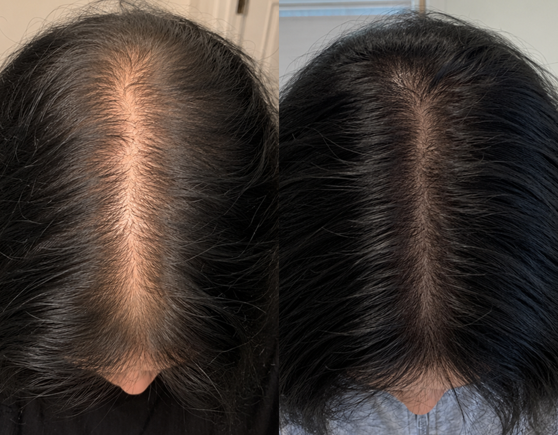 A before-and-after comparison of a person's scalp, showing improved hair density along the part.