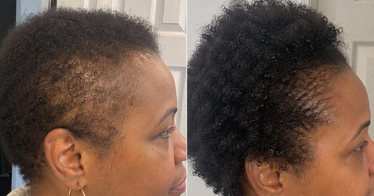 A before-and-after comparison of a woman's hairline, showing thinning hair on the left and fuller hair on the right.