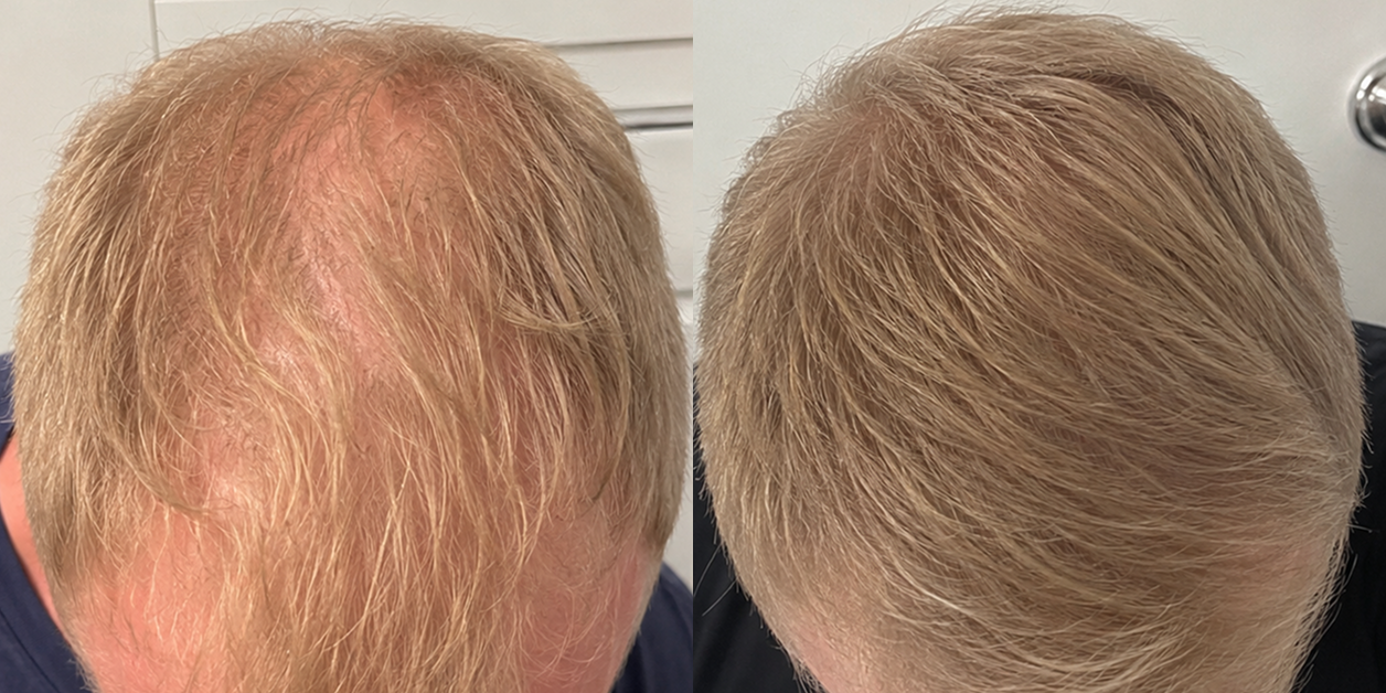 A before and after comparison of a man's thinning blonde hair, showing regrowth and increased thickness.
