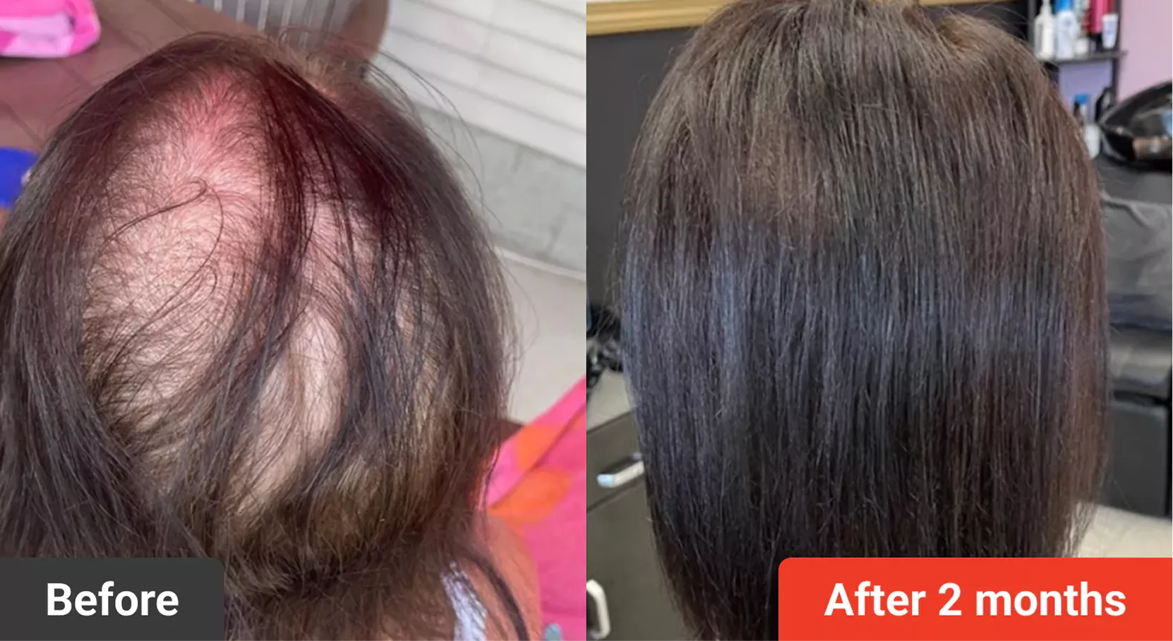 A before-and-after comparison showing significant hair regrowth on a person's scalp over a period of two months.