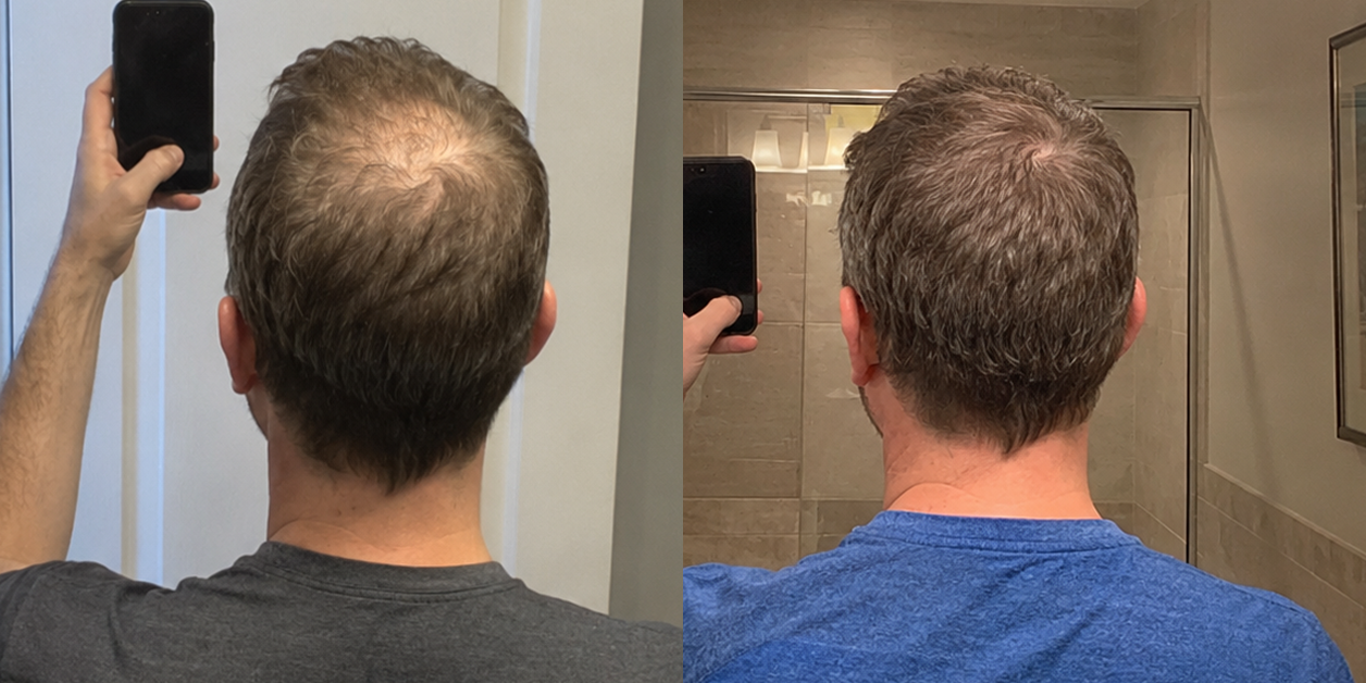 A side-by-side comparison showing the back of a man's head, with hair appearing thicker on the right.