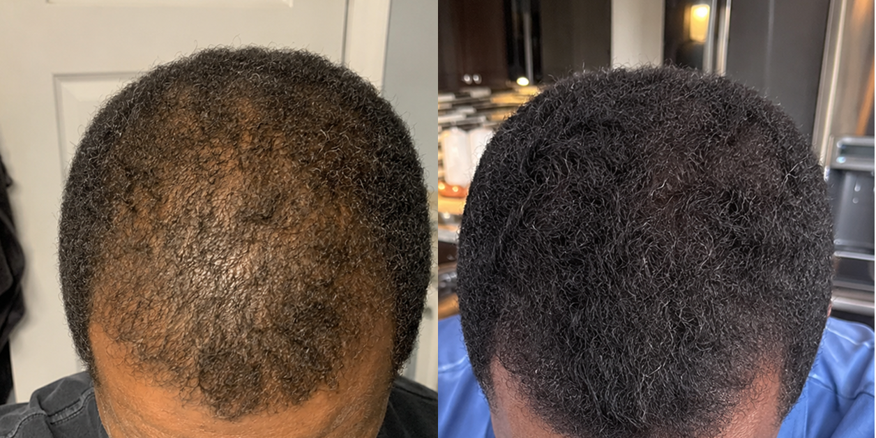 A before-and-after comparison of a man's hair, showing increased thickness and density in the second photo.
