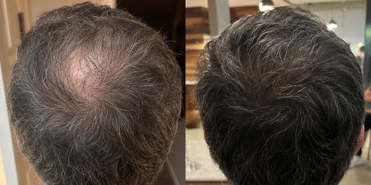 A side-by-side comparison of the back of a man's head showing hair loss and hair growth.